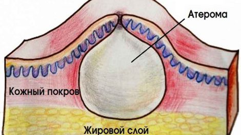 Атерома, или жировик: лечение, как лечить и вылечить в домашних условиях