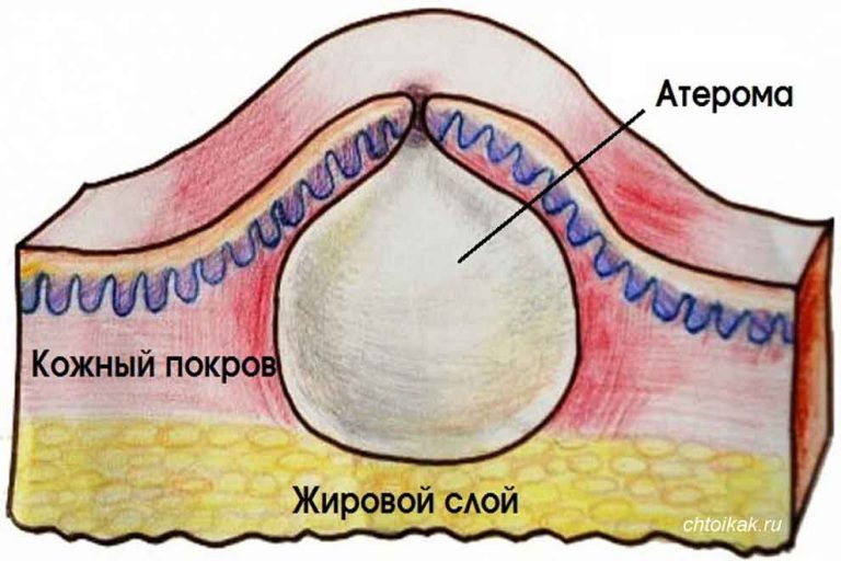 Атерома на лобке фото