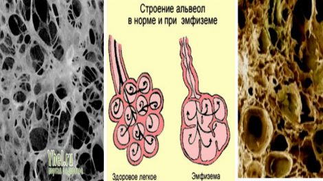 Эмфизема легких: буллезная, симптомы, лечение, прогноз жизни