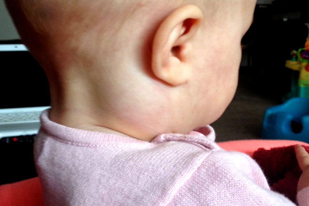 Воспаление лимфоузла за ухом у ребенка фото с пояснениями