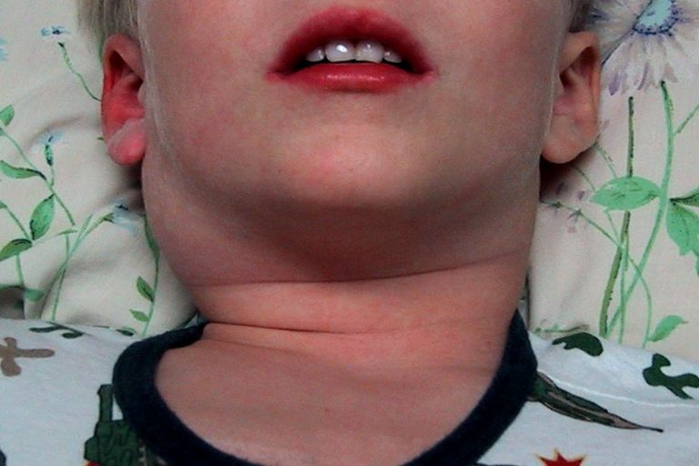 Воспаление лимфоузлов на шее у ребенка причины и лечение фото