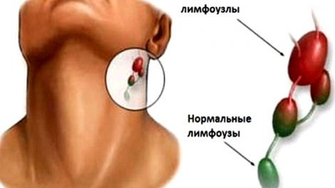 Воспаление лимфоузлов под челюстью: лечение, причины, как лечить на шее