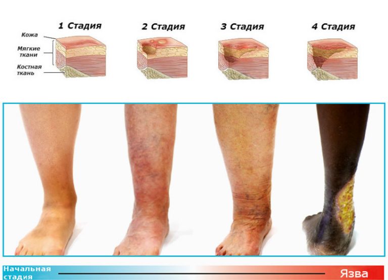 Трофическая язва на ноге: лечение в домашних условиях | Радуга