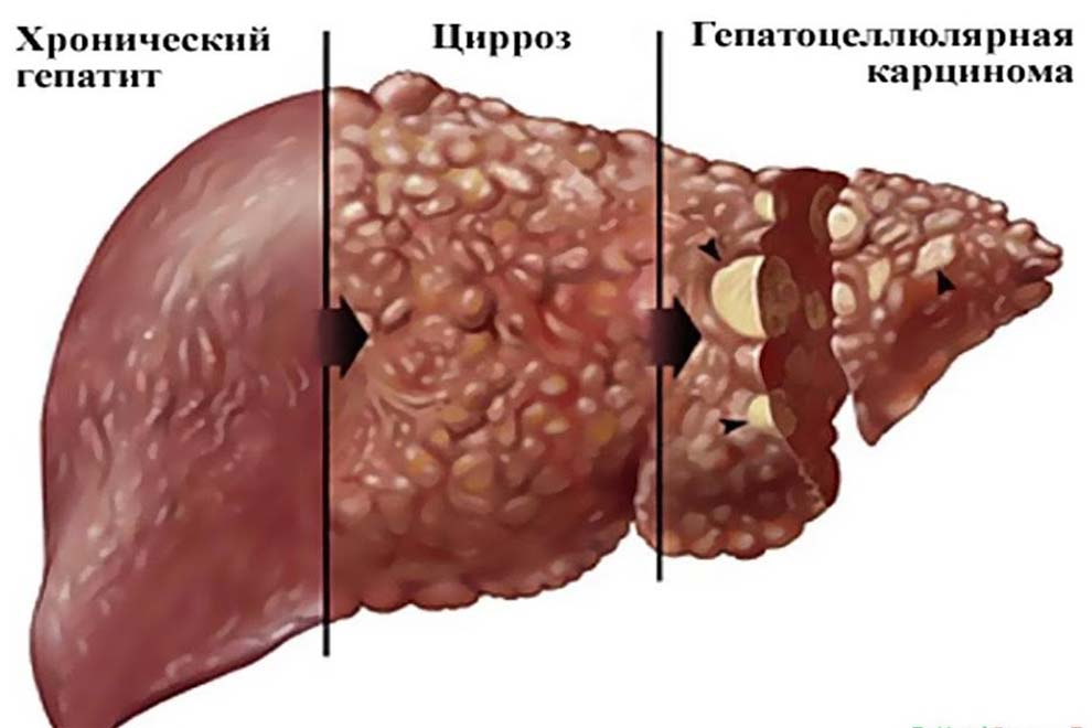 Самые неблагоприятные исходы и осложнения гепатита С