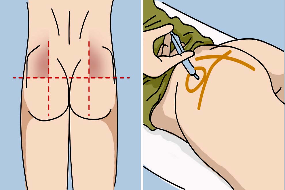 Укол в ягодицу самостоятельно схема фото пошагово в домашних условиях