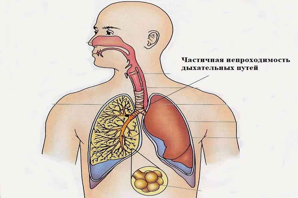 Нарушение проходимости дыхательных путей у детей диагностика и интенсивная терапия тесты с ответами